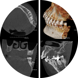 レントゲン、口の写真